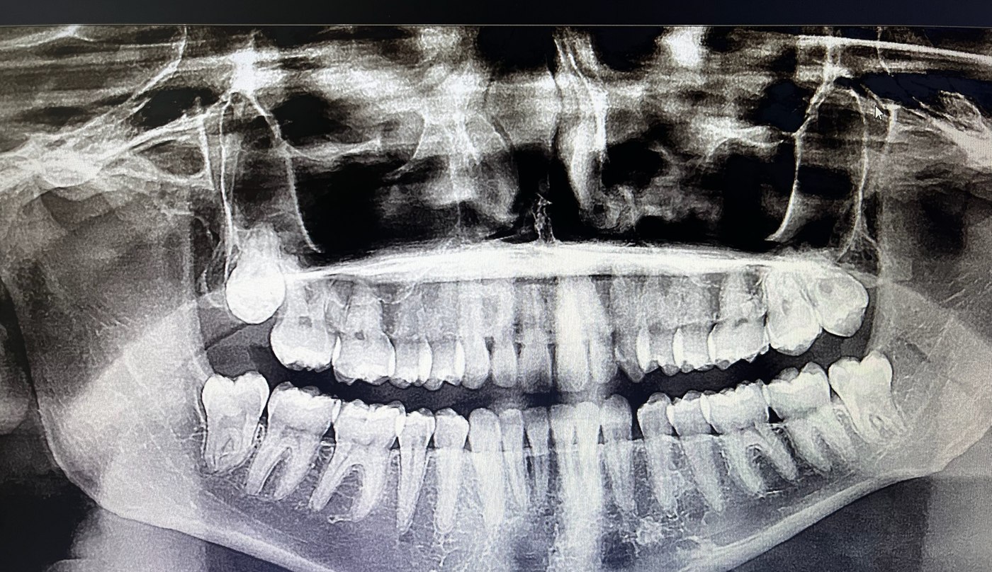 Radiografia panorâmica mostrando terceiro molar superior deslocado, próximo à região do seio maxilar.