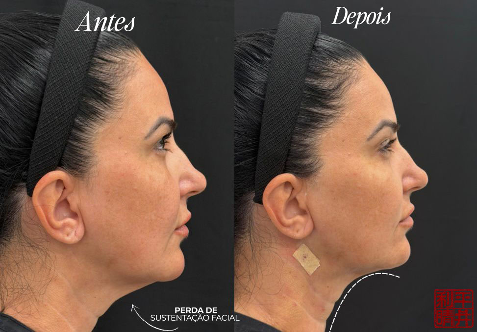 Comparação de antes e depois do perfil facial, lado a lado.